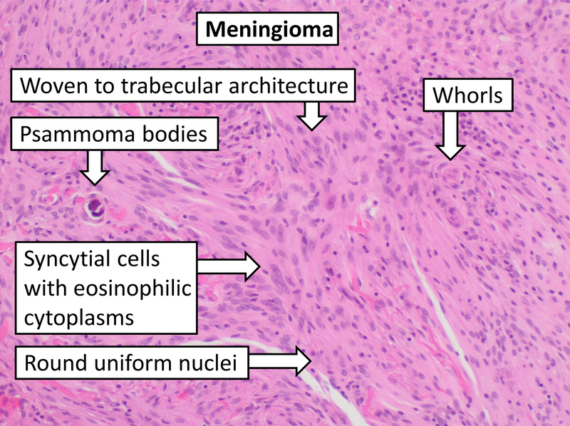 File:Histopathology of meningioma.png