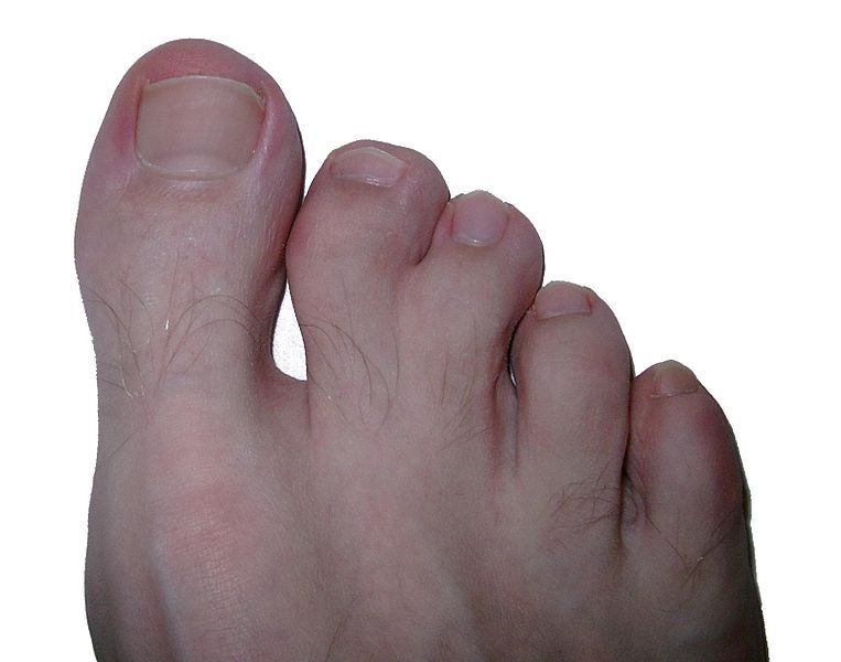 File:Syndactily feet.jpg