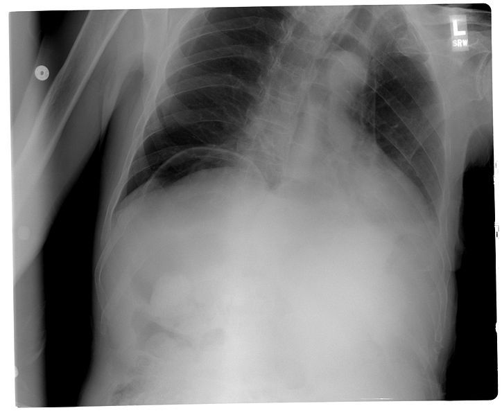 File:Pneumoperitoneum chest X-ray.jpg