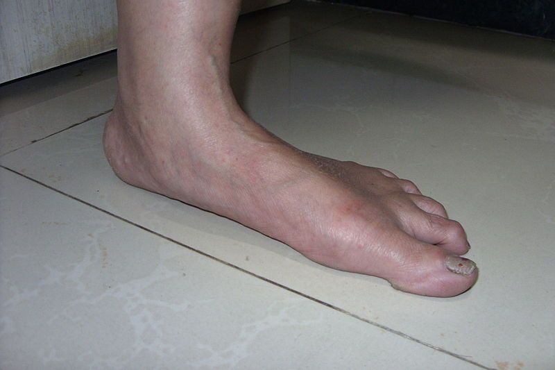 File:Adult Flatfoot.JPG