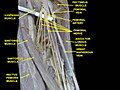 Great saphenous vein. Deep dissection. Anterior view.