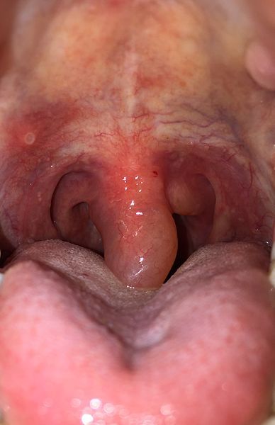 File:Swollen Uvula.jpg