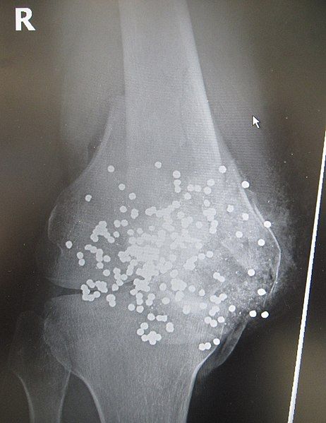 File:Shotgun wound-xray.JPG