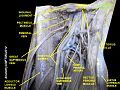 Iliopsoas muscle