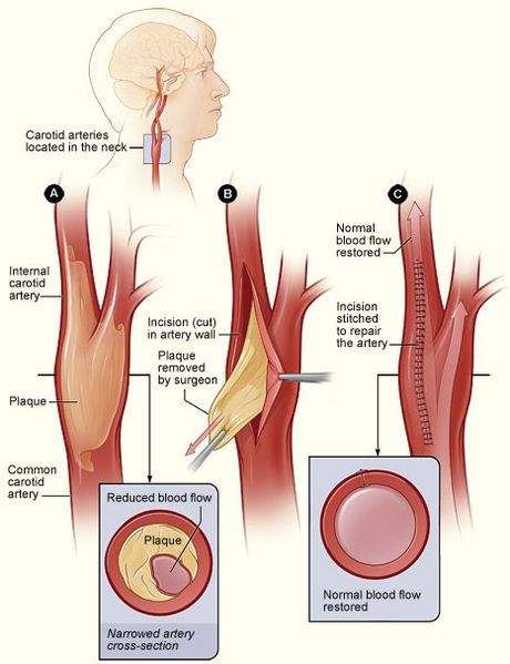 File:Cad endarterectomy.jpg