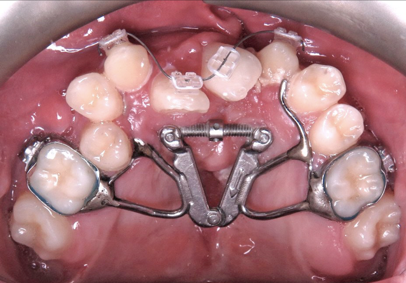 File:Fan palatal expander.png