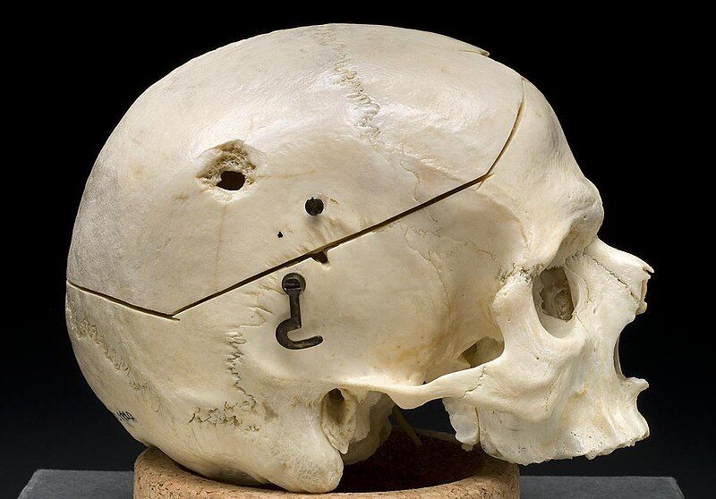 File:Gunshot skull.jpg