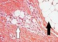 Lipoblasts (white arrow) and lipocytes (black arrow), in a case of lipoblastoma