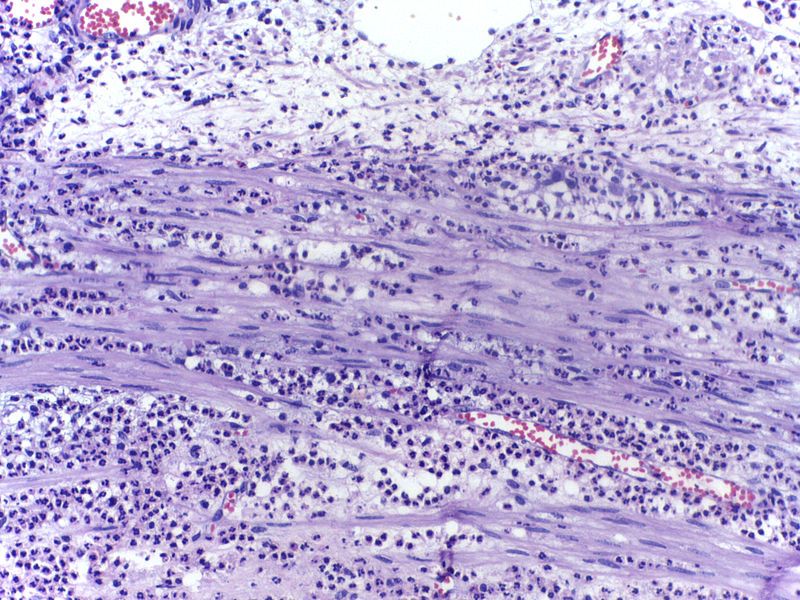 File:Neutrophils -1.jpg