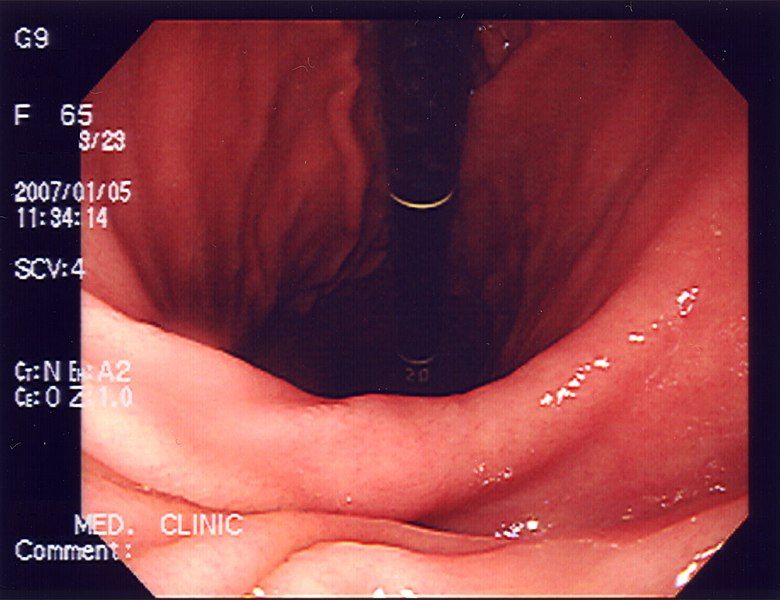 File:Stomach endoscopy 2.jpg