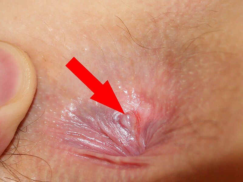 File:Anal fissure 1.jpg