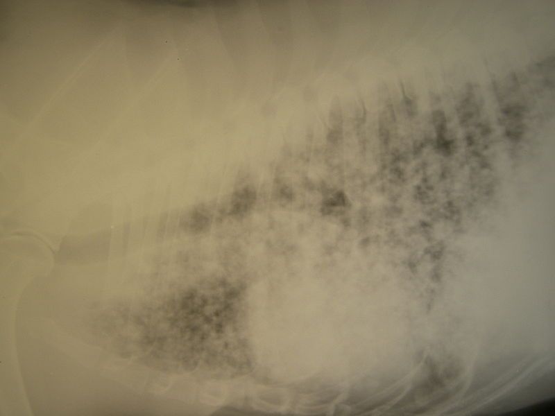 File:Carcinome mammaire métastatique.jpg