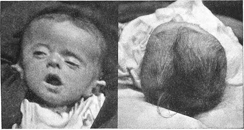 File:Plagiocephaly Greig.jpg