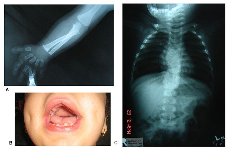 File:Robinow syndrome2.jpg