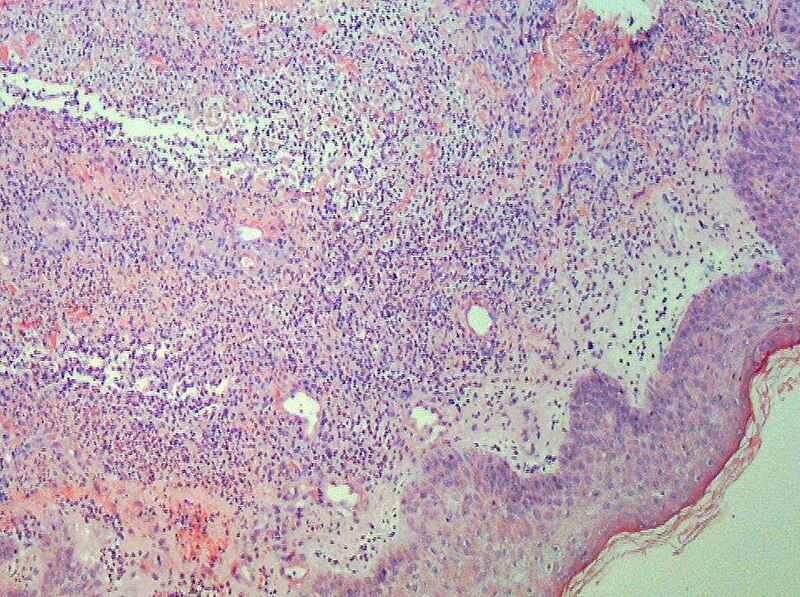 File:Sweet's syndrome pathology.jpg