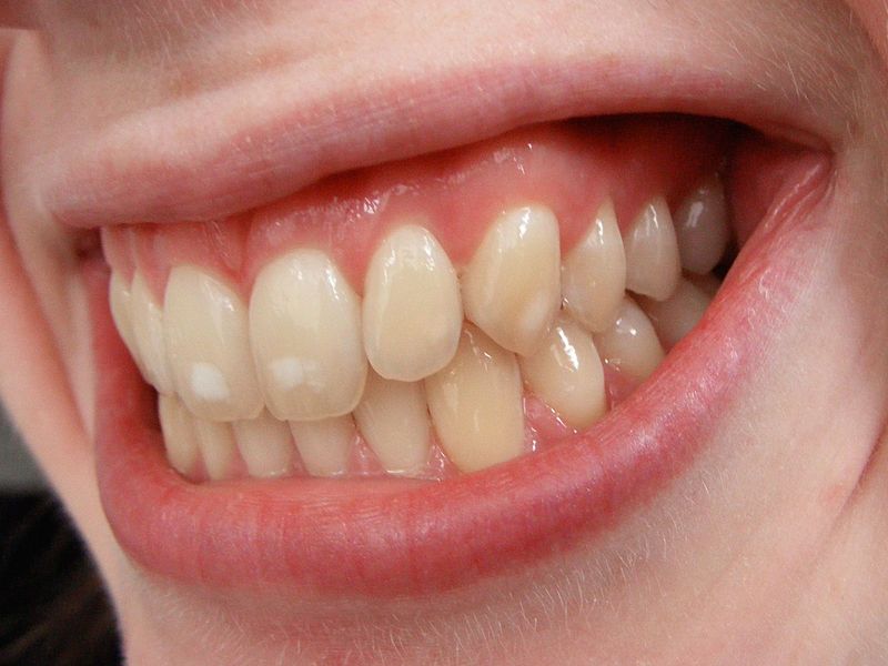 File:Dental fluorosis.jpg