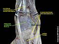 Pronator quadratus muscle