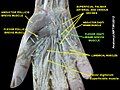 Flexor digiti minimi brevis muscle