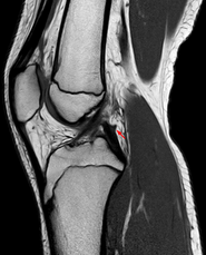 Posterior meniscofemoral ligament on MRI, sagittal