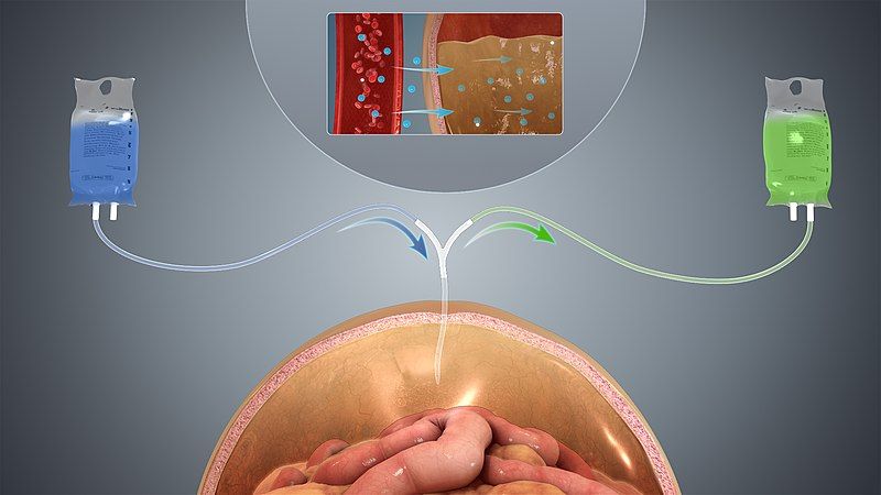 File:Peritoneal dialysis.jpg