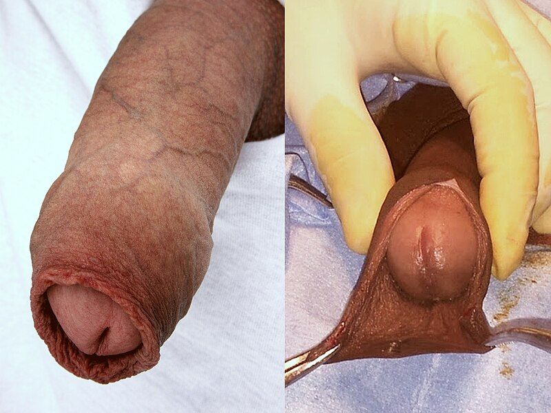 File:Circumcision surgery.jpg