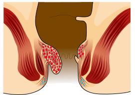 File:Piles Grade 2.svg