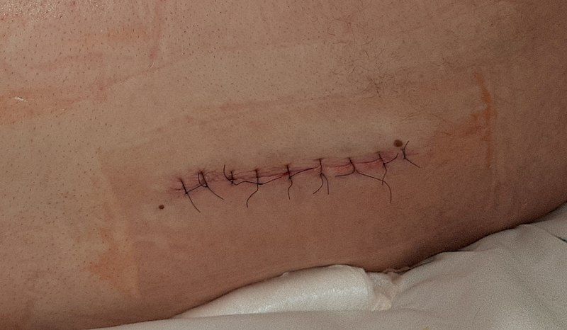 File:Surgical suture.jpg