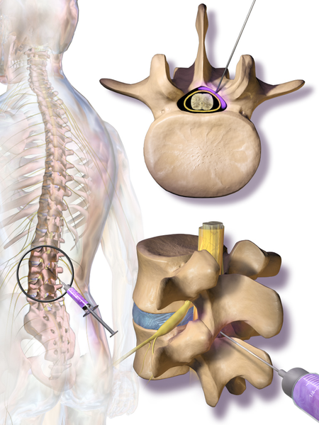 File:Blausen 0354 EpiduralSteroidInjection.png