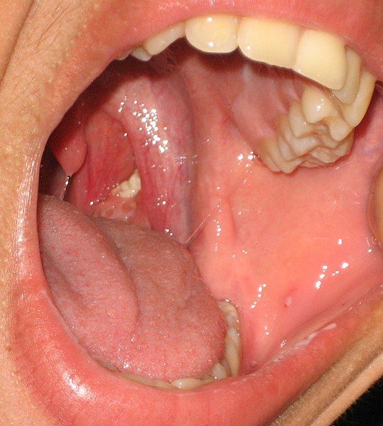 File:Tonsillolith in mouth.jpg