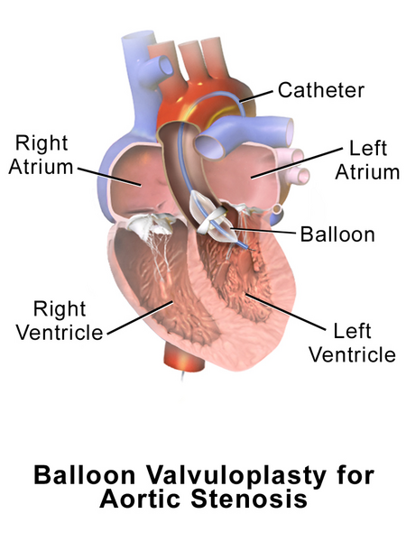 File:Valvuloplasty Aortic.png