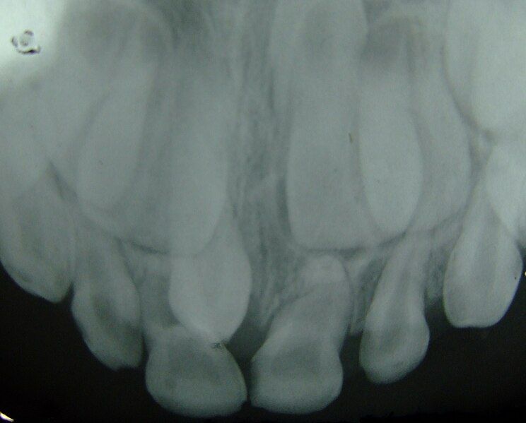 File:Supernumerary teeth.jpg