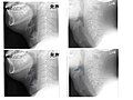 Left column: Normal epiglottis. Right column: Epiglottitis.