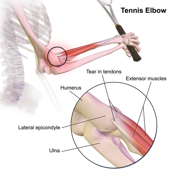 File:Tennis Elbow.png