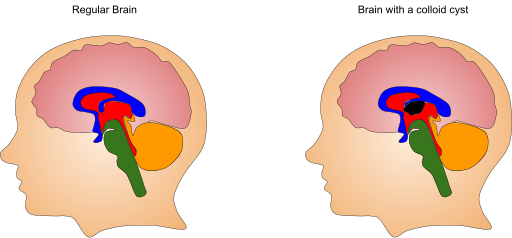 File:Colloid Cyst.svg