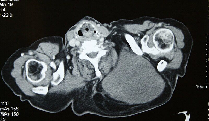 File:Liposarcoma 02.jpg