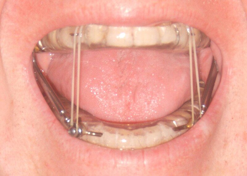 File:Mandibular advancement splint.jpg