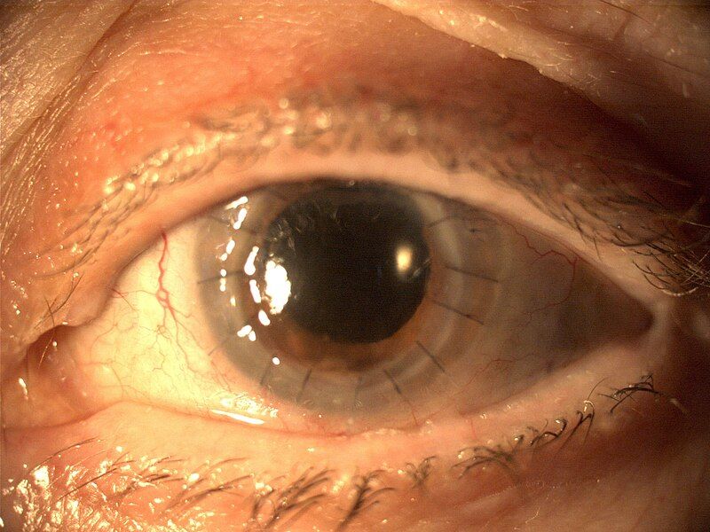 File:Penetrating keratoplasty.JPG