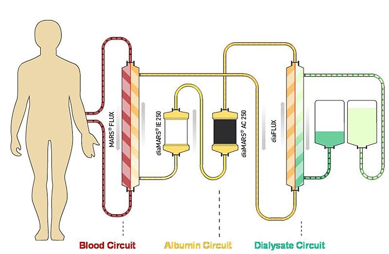 File:Albumin dialysis circuit.jpg