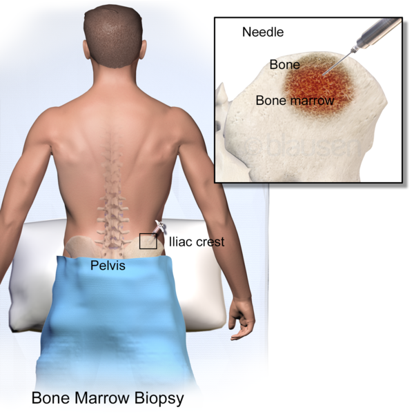 File:Blausen 0097 BoneMarrowBiopsy.png