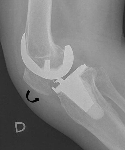 File:Patella baja.jpg