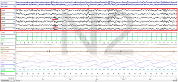 Stage N2 Sleep. EEG highlighted by red box. Sleep spindles highlighted by red line.