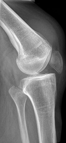 File:Quadriceps Ruptur Roe1.jpg