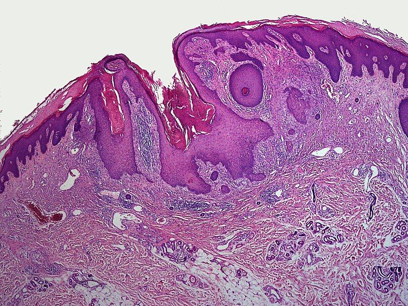 File:SkinTumors-P8210645.JPG