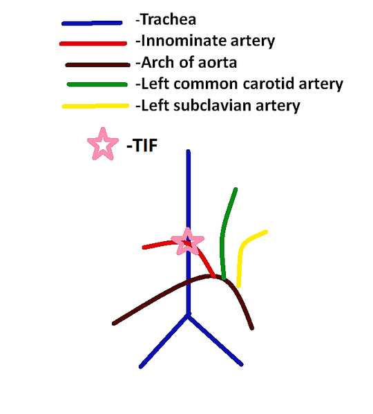 File:Tracheoinnominate fistula.png