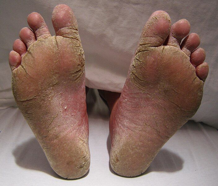 File:FeetFungal.JPG