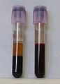 Two tubes of EDTA-anticoagulated blood. Left tube: after standing, the RBCs have settled at the bottom of the tube. Right tube: Freshly drawn blood