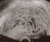 Molar pregnancy