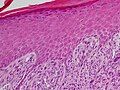 Spindle-cell squamous-cell carcinoma