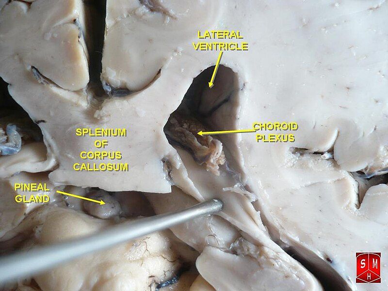 File:Choroid plexus.jpg