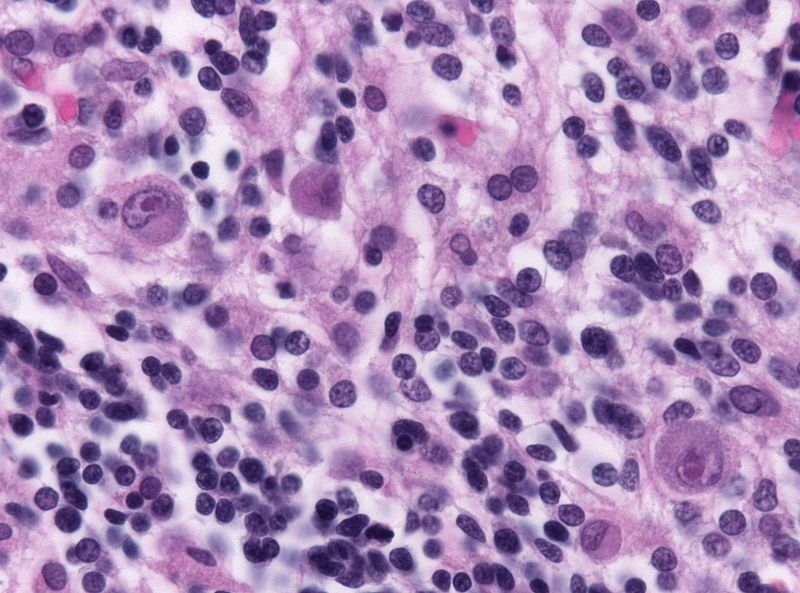 File:Cmv neuronal inclusions.jpg